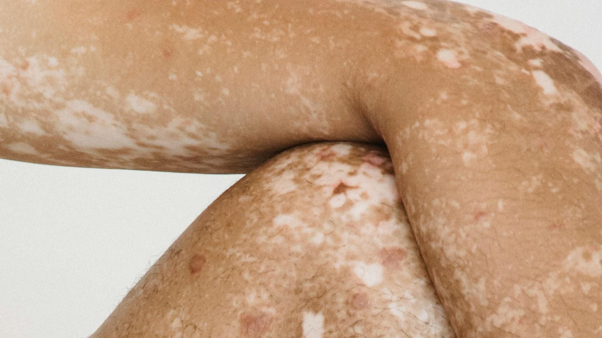 skinome_16x9_vitiligo_2.jpg