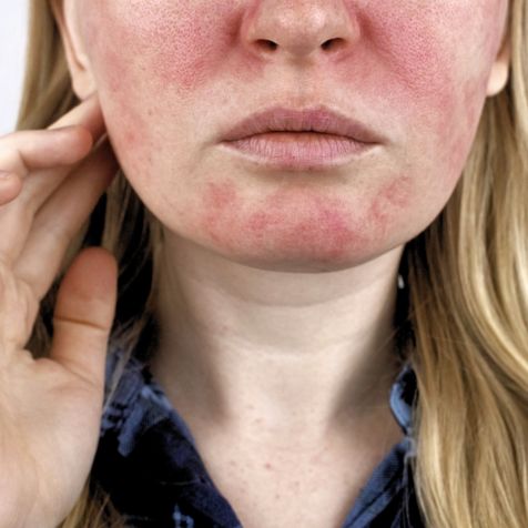 skinome_5tips_rosacea_2_177bafe9-130c-46e1-b3b7-743c379d3d8b.jpg