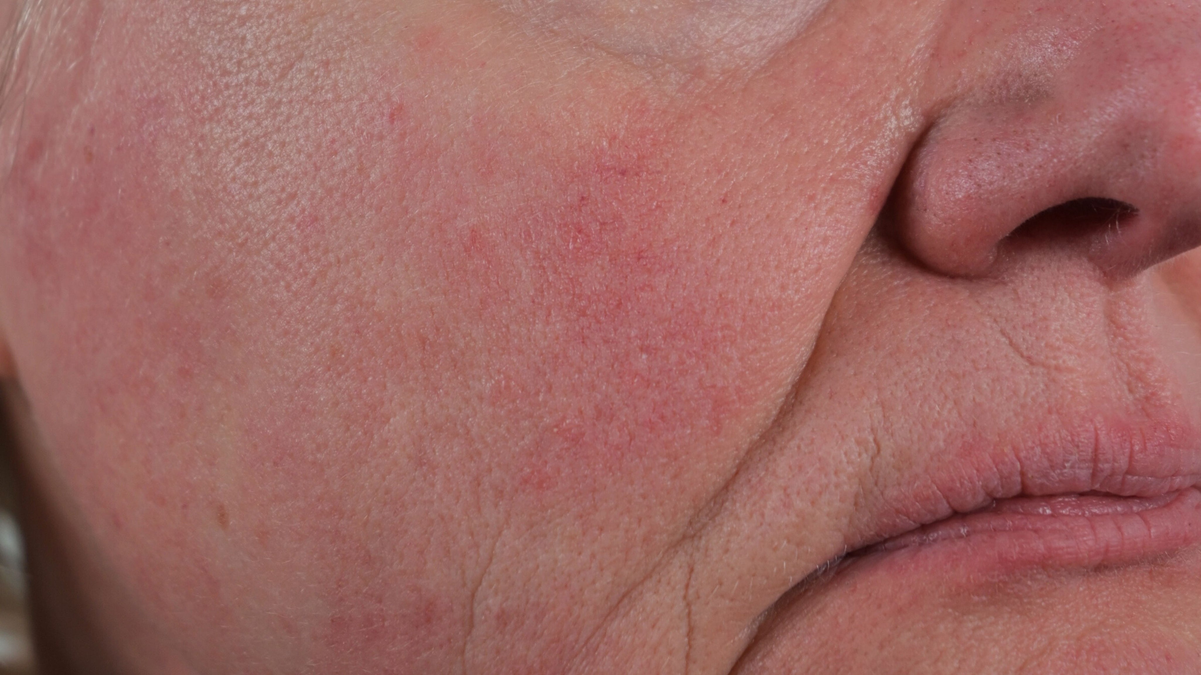 skinome_rosacea_16x9_c85532eb-38c8-4b03-9b59-1ba552d4e9ea.jpg