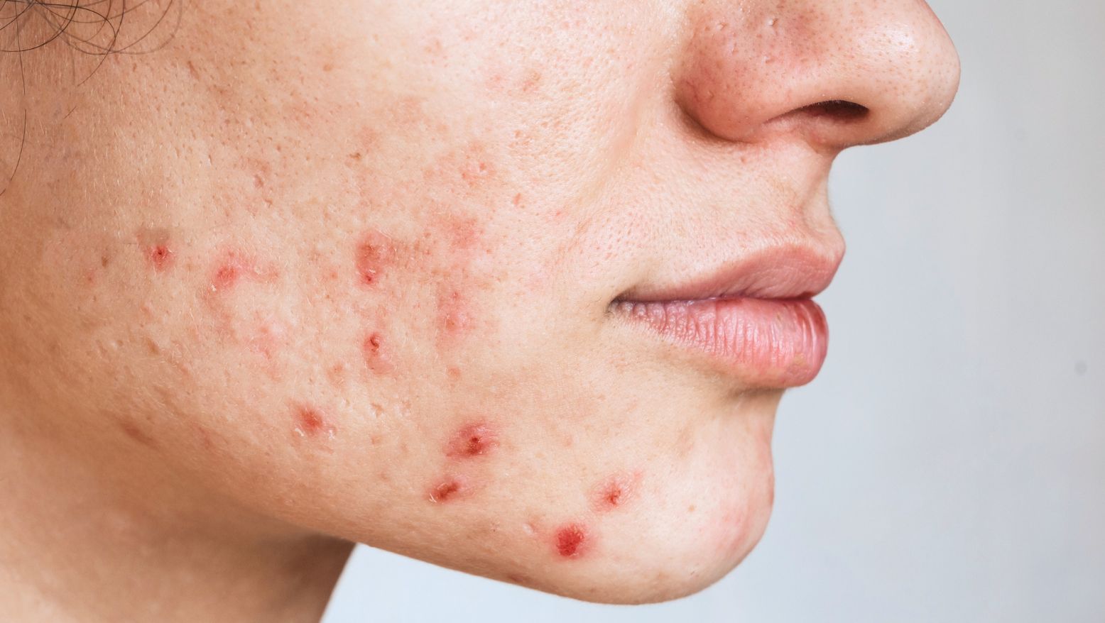 Närbild på hud med akne och inflammerade utslag