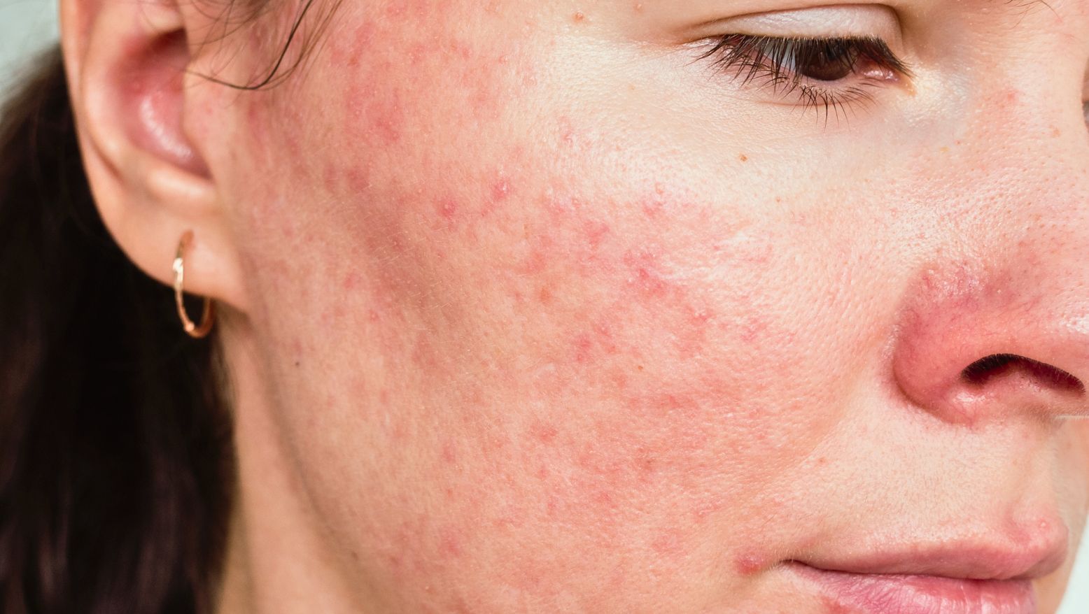 Ansikte med rosacea och synliga blodkärl i huden