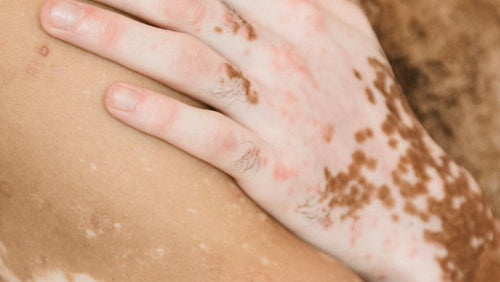 Vit hudfläck på arm – visar typiskt utseende vid vitiligo, en kronisk hudsjukdom med förlorat pigment