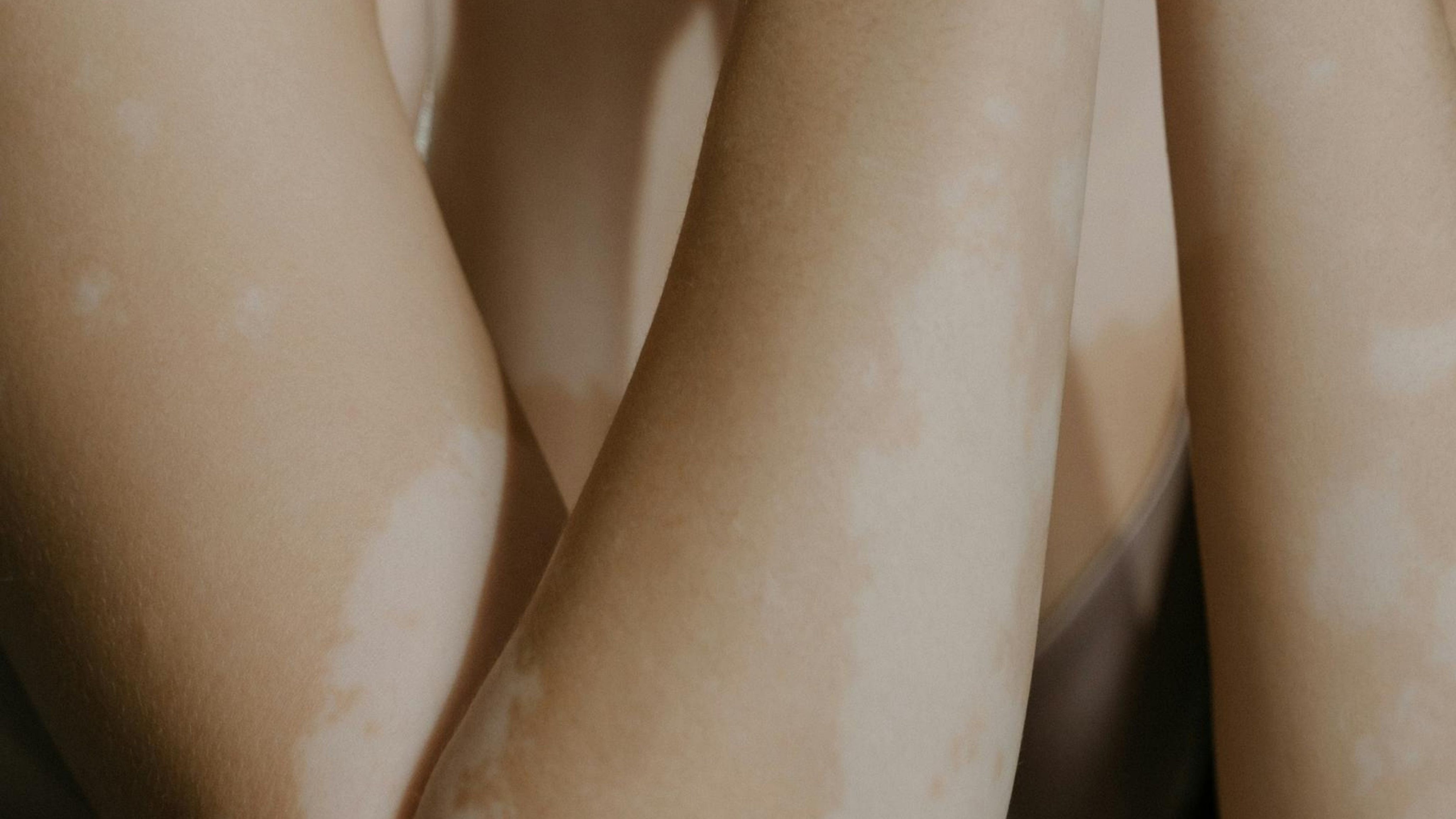 Hudvårdsrutin för vitiligobenägen hud