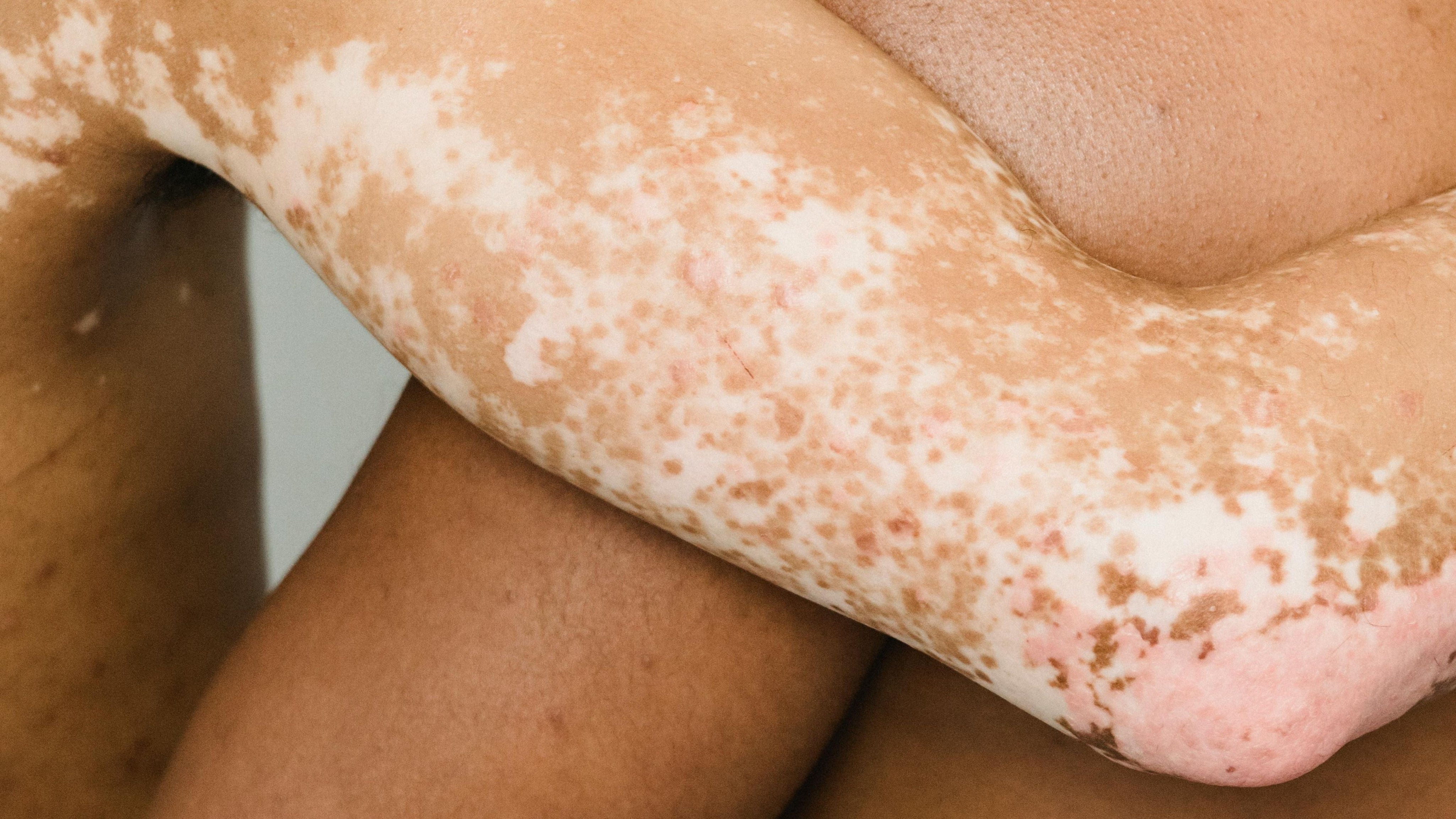 Vad händer i huden vid vitiligo?