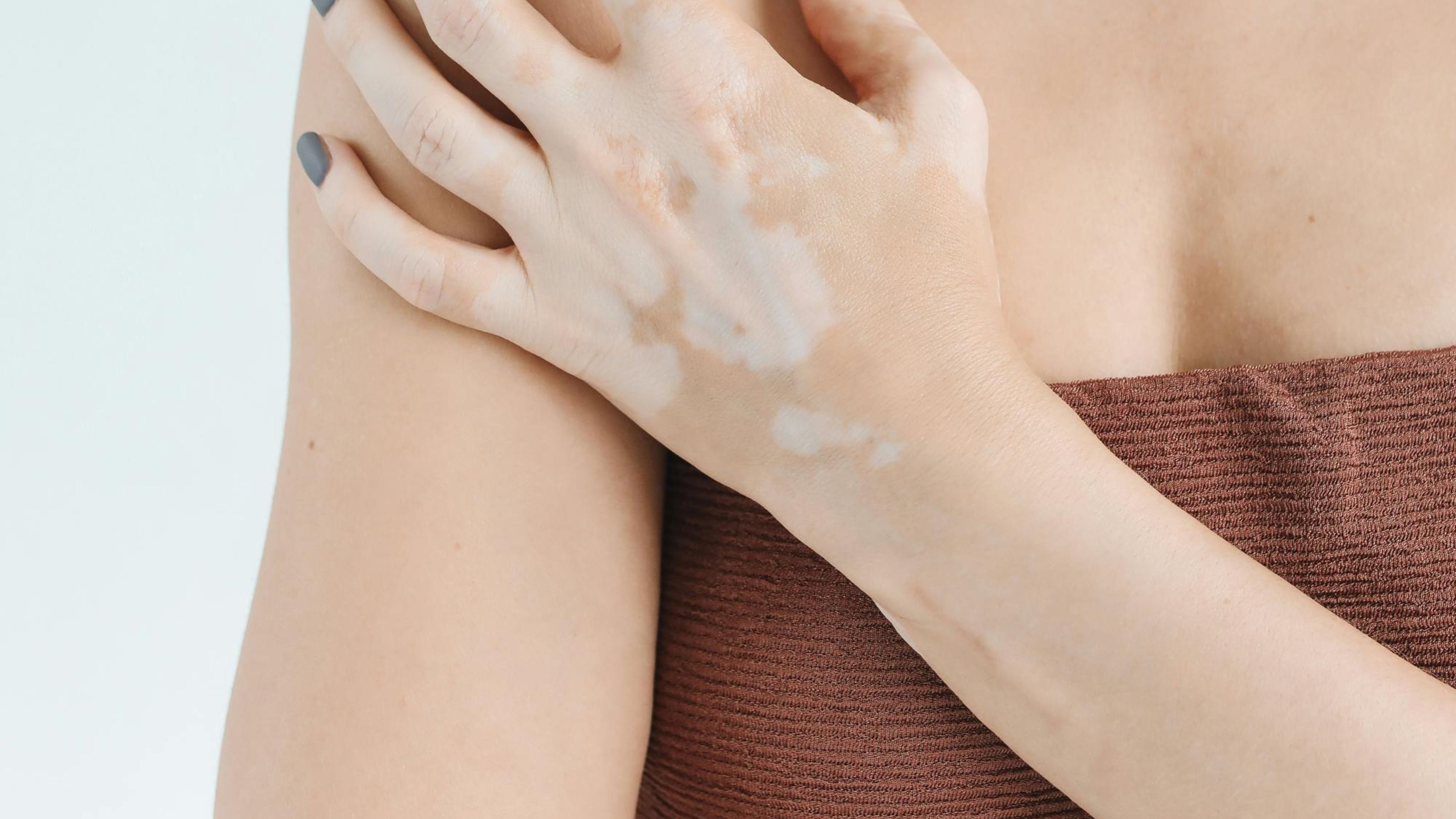 Vitiligo – från “kosmetiskt fel” till möjlig styrka