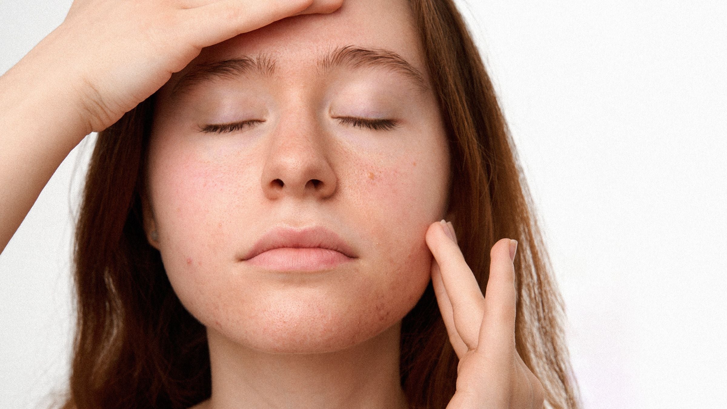 Hormonell akne, varför den uppstår och varför många behandlar den fel