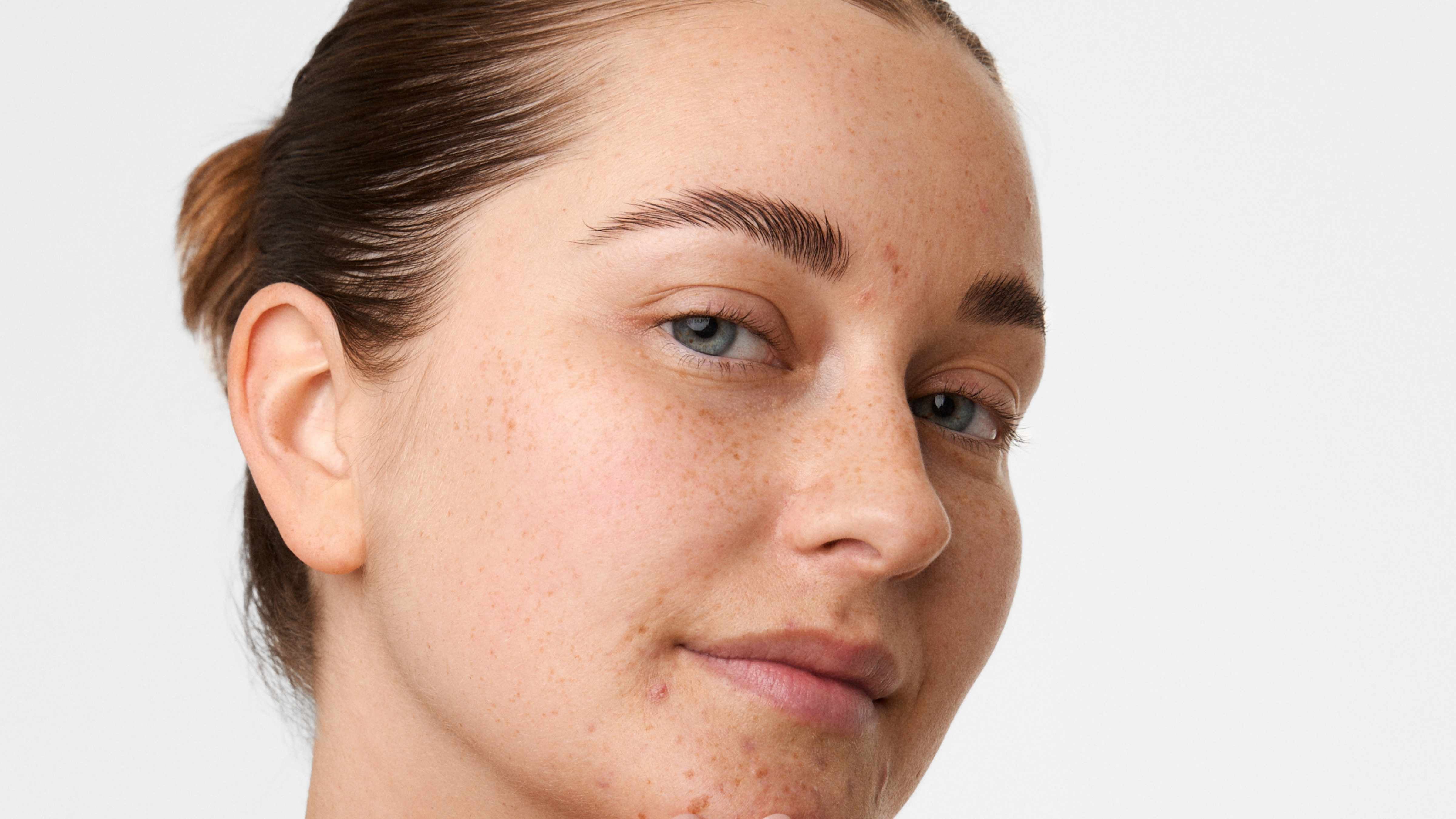 Vuxenakne – orsaker och tips för att minska besvären