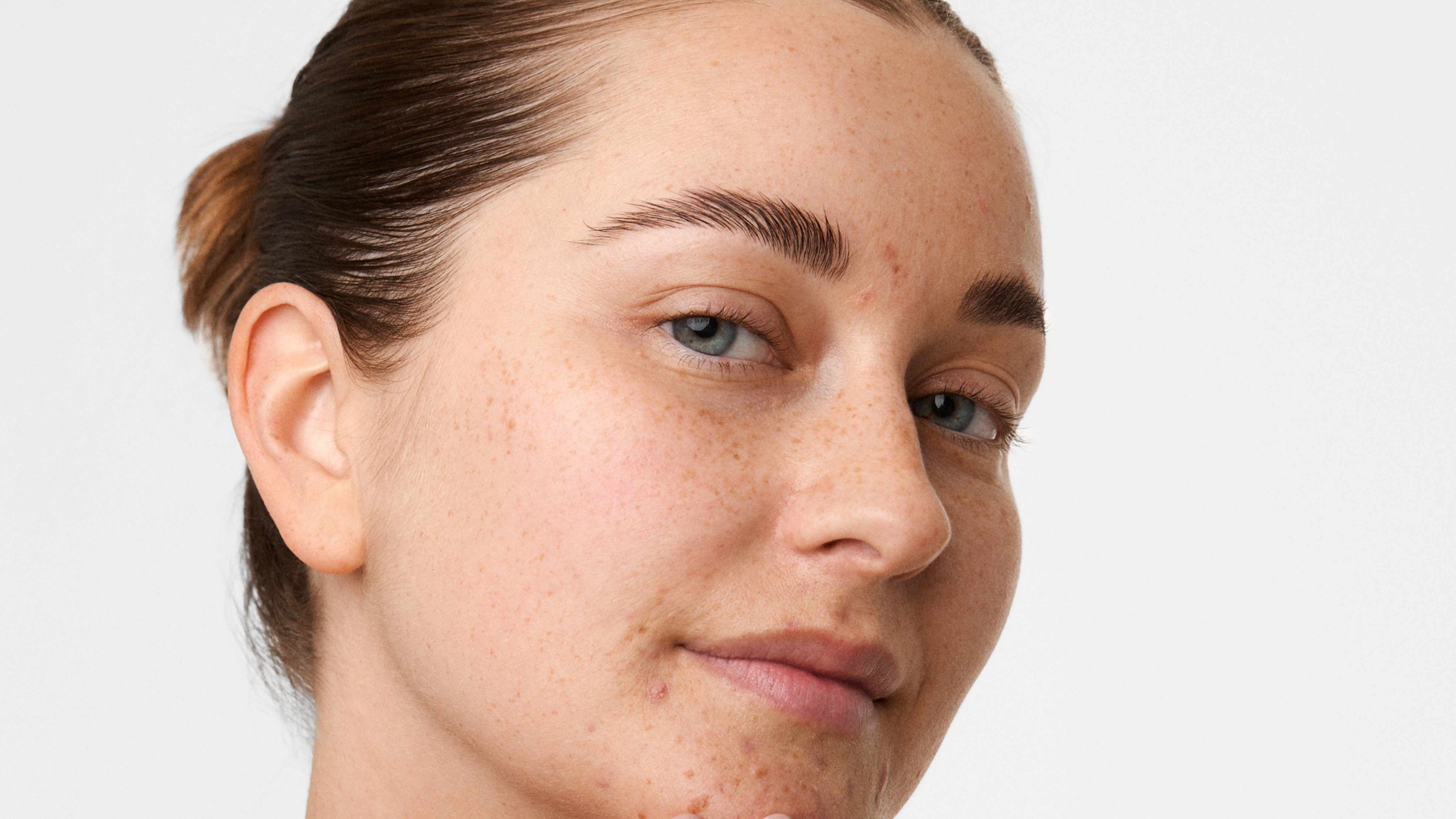 Vuxenakne – orsaker och tips för att minska besvären