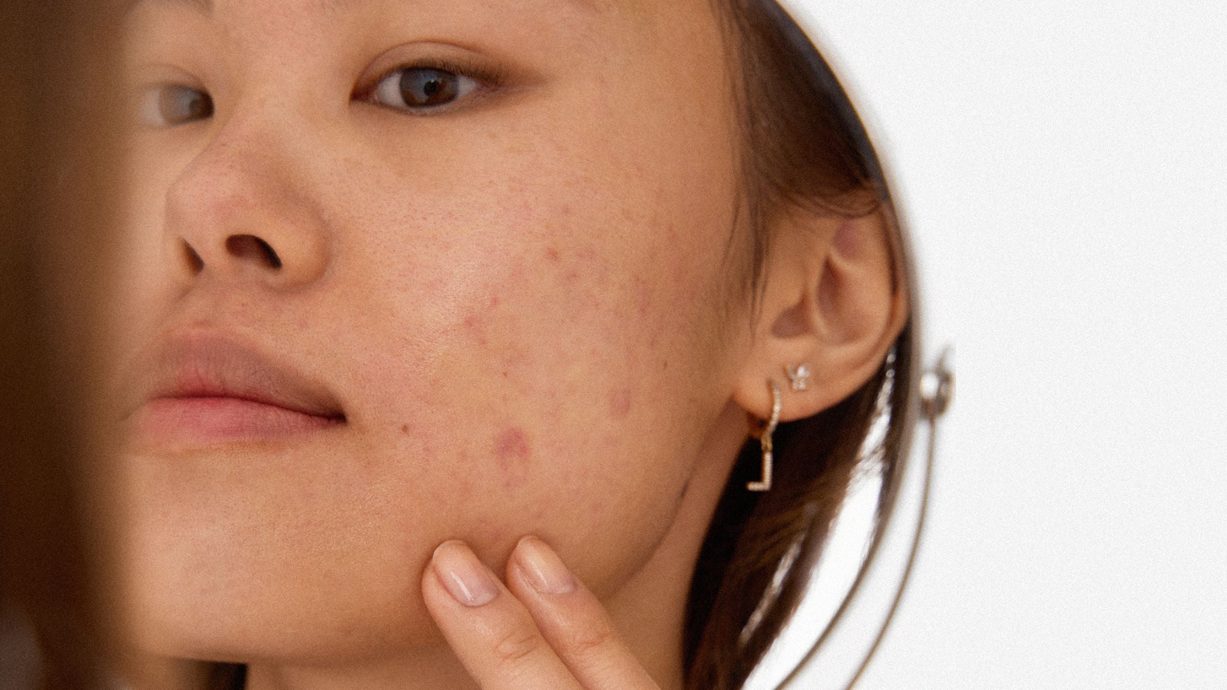 PCOS och huden - Hormonell akne, finnar & hudvård