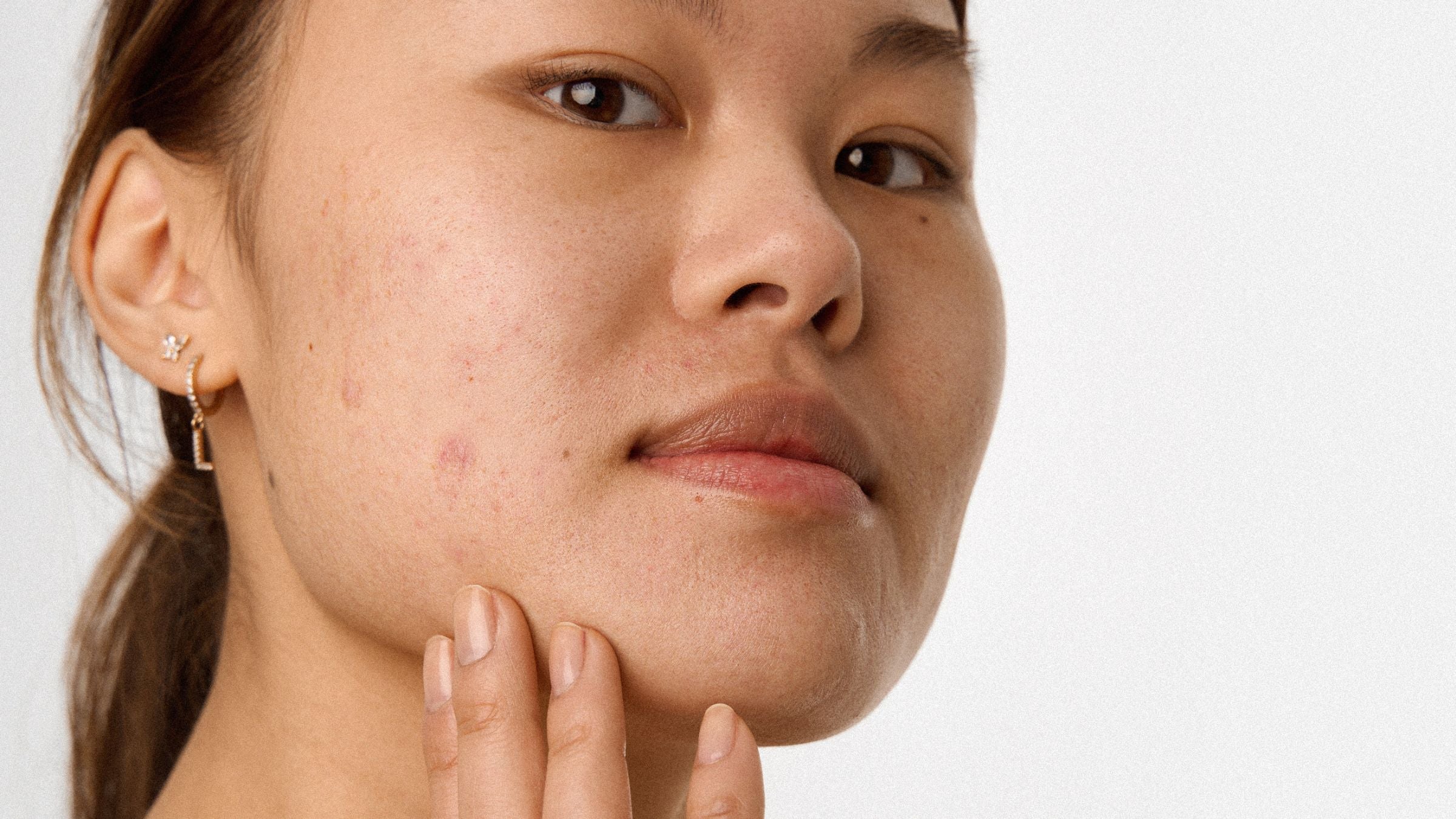 Våra bästa tips för aknebenägen hud