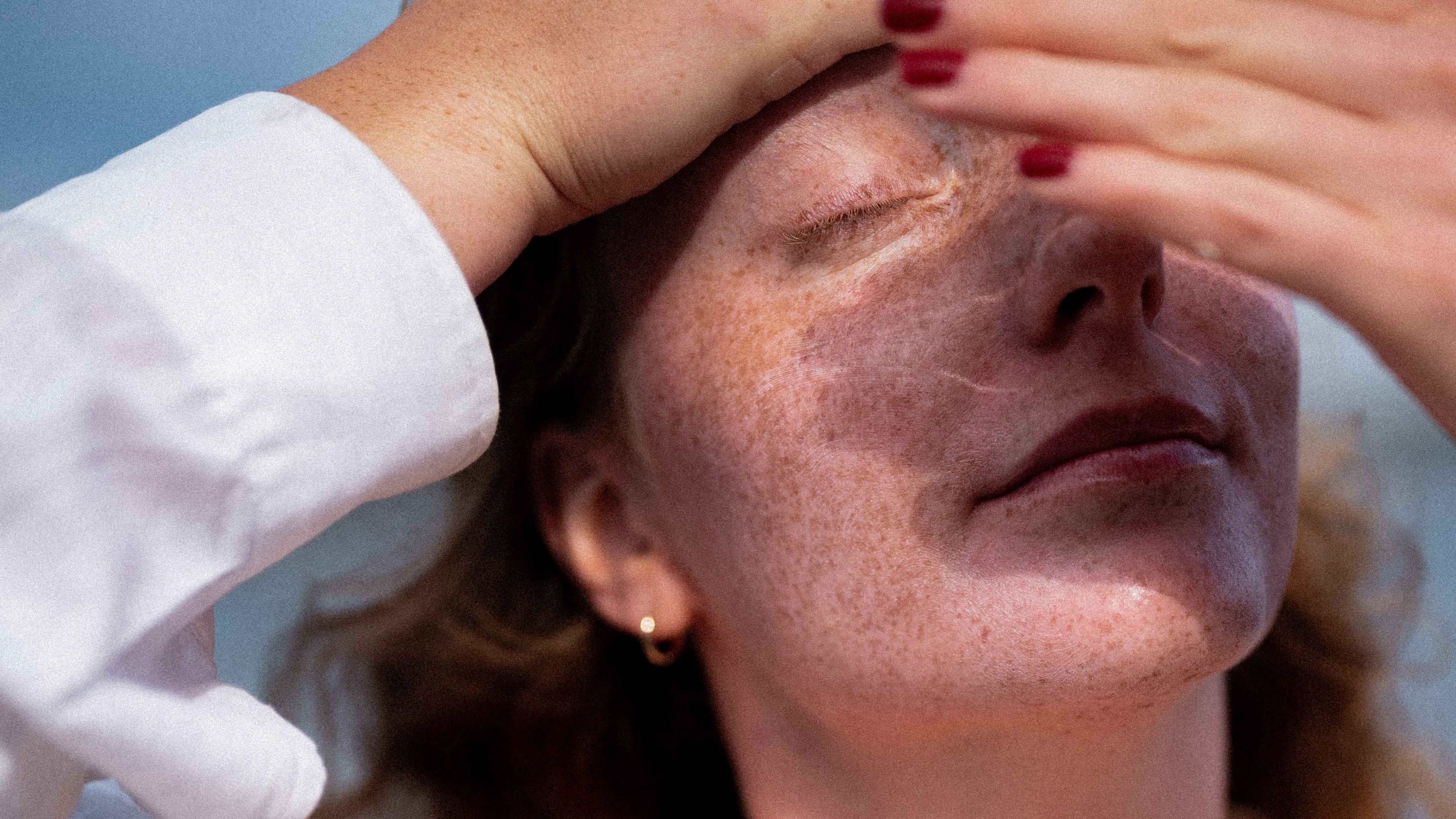 Varför triggar solen rosacea och vad händer i huden?