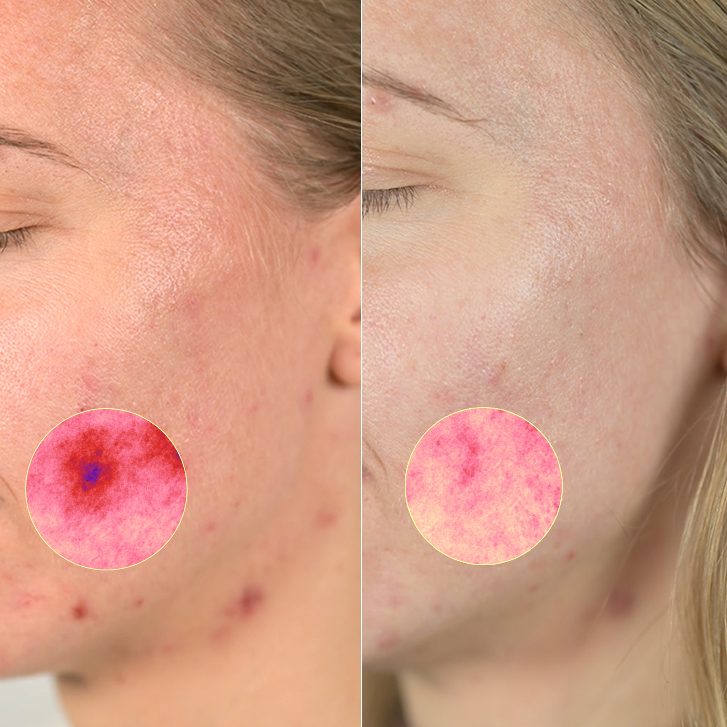 33 % reduksjon i rødhet