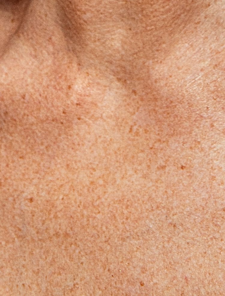 SKINOME_SUN_pigmentflackar_MOBILE.jpg
