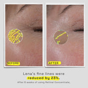 Before/after picture of skin after 6 weeks of using Retinal Concentrate. Lena's fine lines were reduced by 23%.