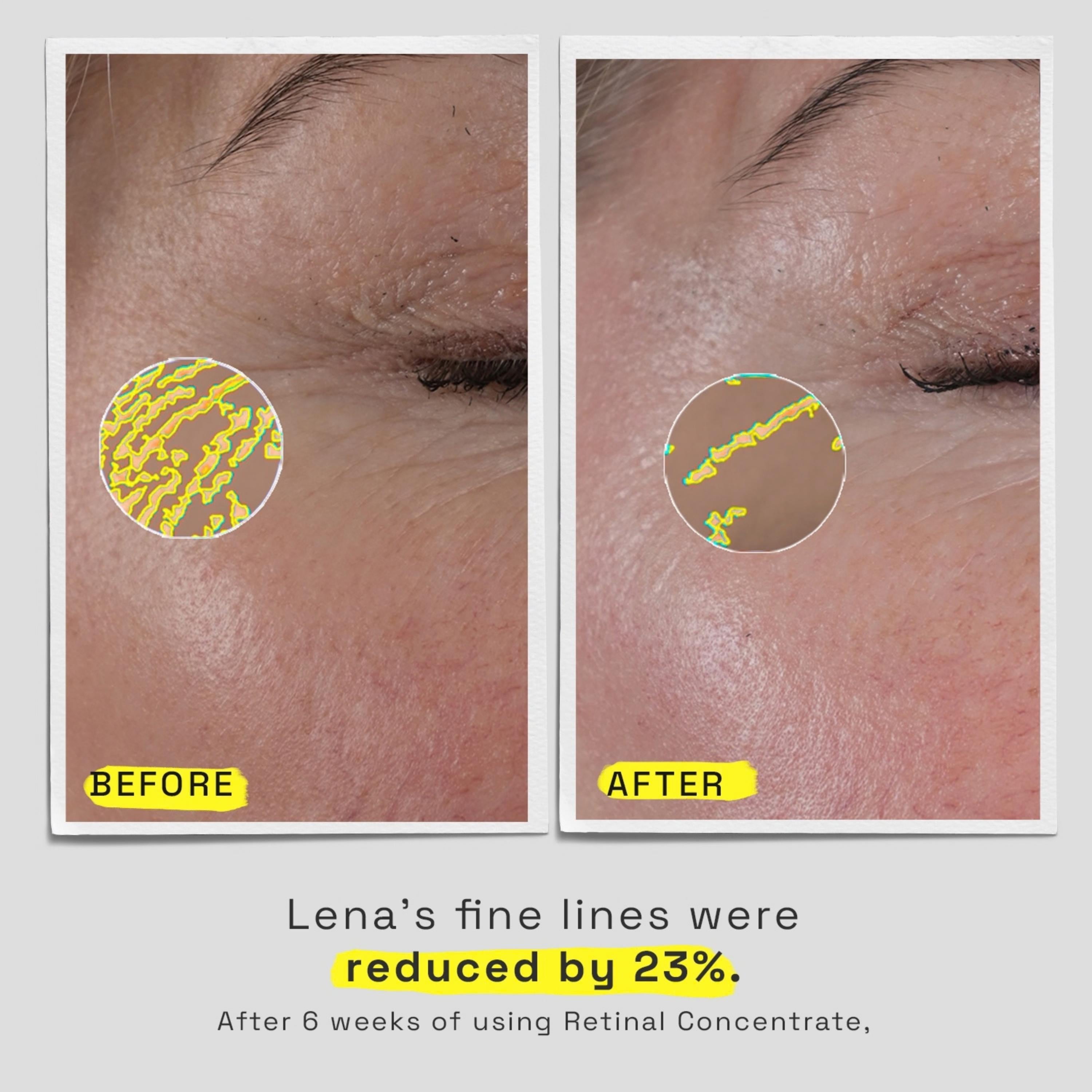 Before/after picture of skin after 6 weeks of using Retinal Concentrate. Lena's fine lines were reduced by 23%.