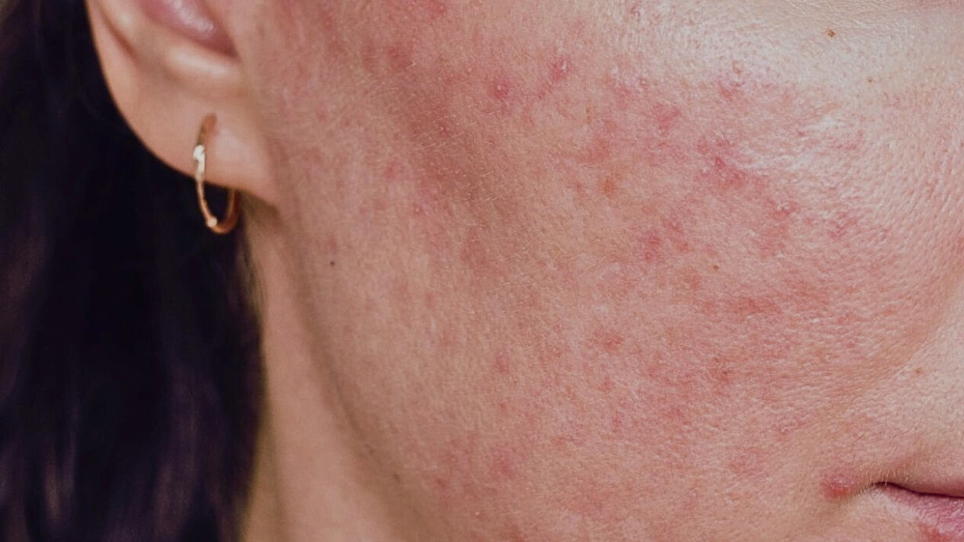 skinome_rosacea_16x9_2.jpg