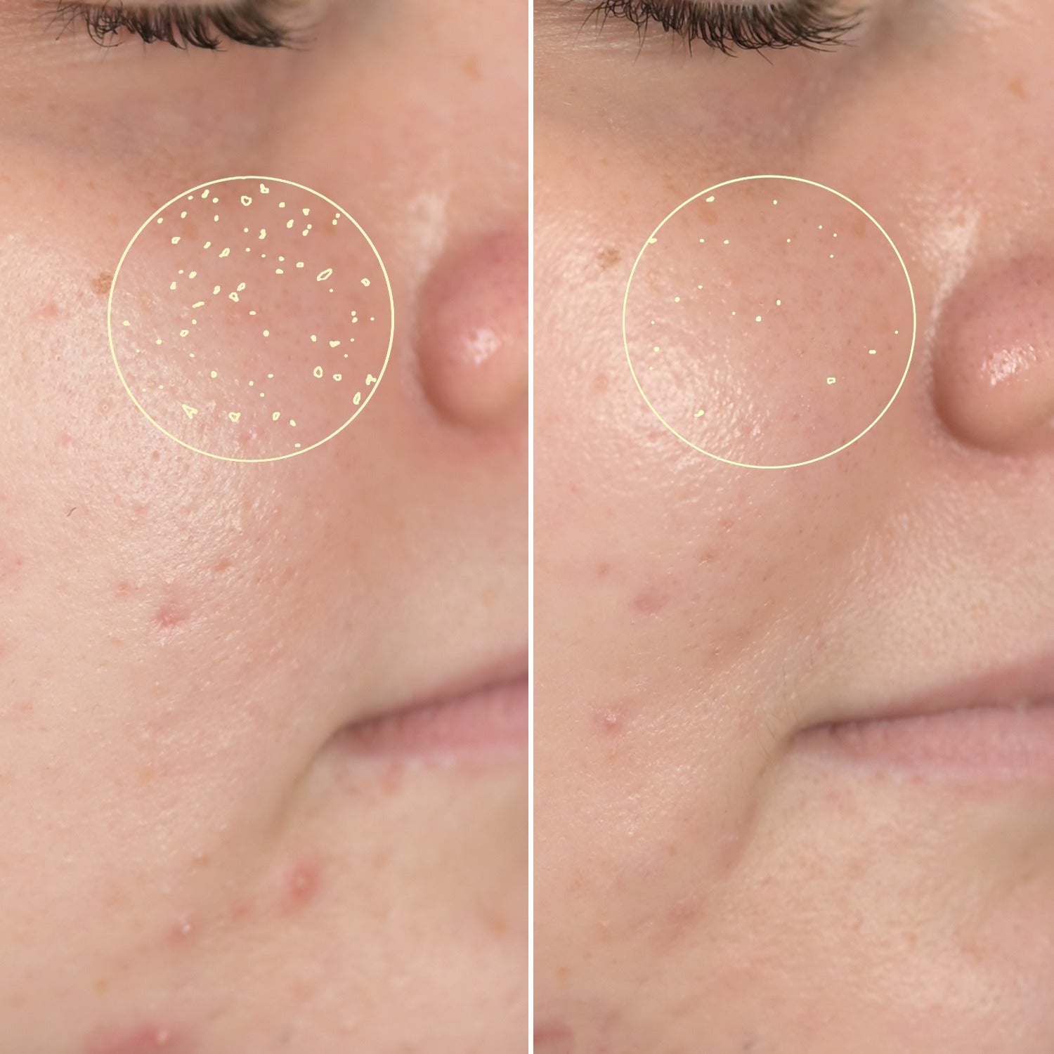 52 % redusert porestørrelse