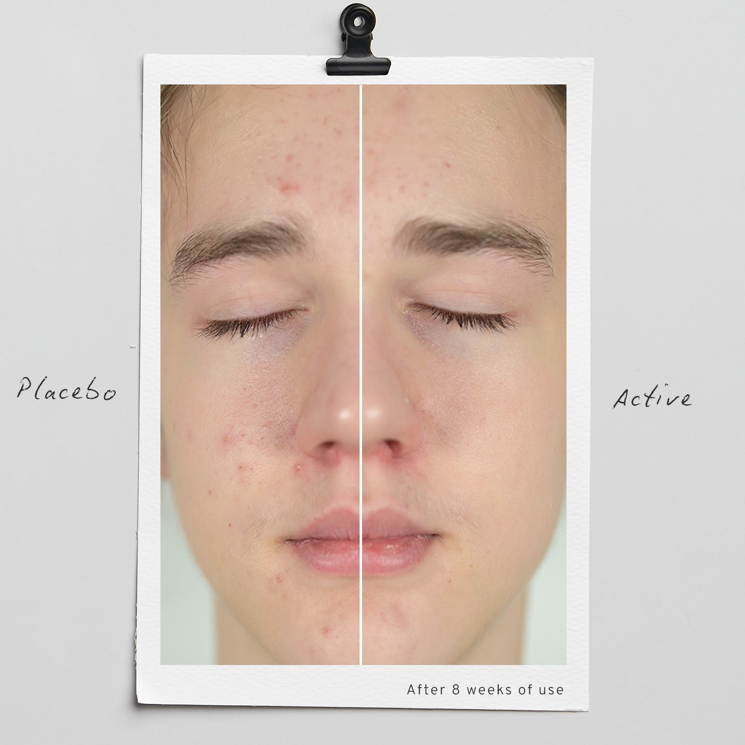 Acne-prone Balance Trio