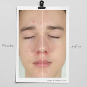 Acne-prone Balance Trio